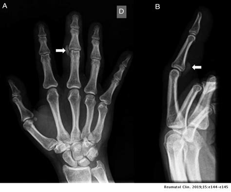 acute calcific periarthritis  proximal interphalangeal joint