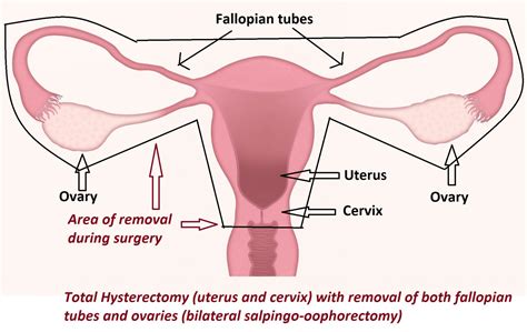 hysterectomy removal of the uterus obstetrics