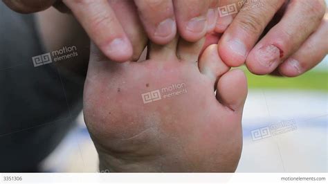 man discovers itchy athletes foot growth  toes stock