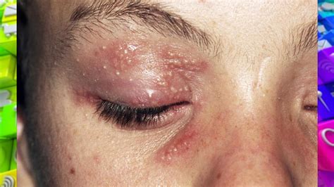 Can You Get Herpes On Your Eyes And Hands The Doctors