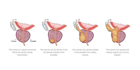 Urology Treatment By Best Urology Surgeons In India Rg Hospital