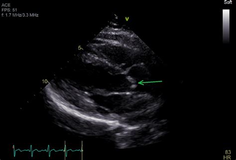 Cureus A Rare Case Of Unicuspid Aortic Valve With Postoperative Heart