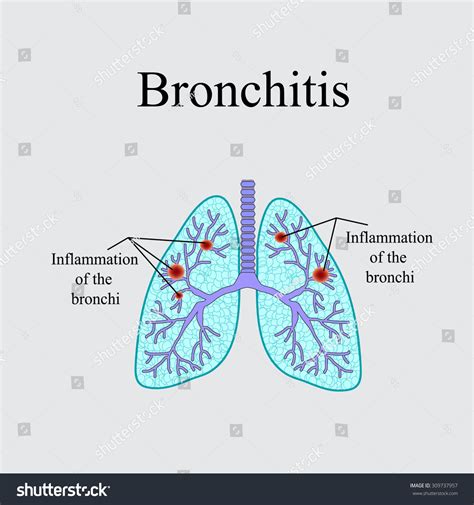 Bronchitis Anatomical Structure Human Lung Vector Stock Vector Royalty