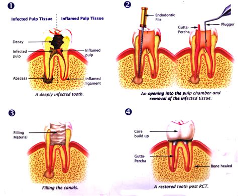 root canal treatment prestige dental care