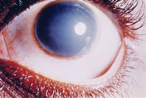 corneal dystrophy congenital endothelial  hereditary ocular diseases