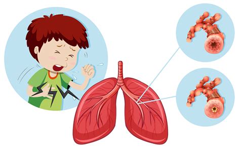 asthma respiratory tract disorders  diseases articles