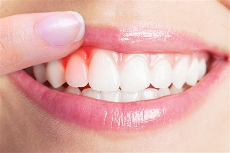gum disease treatment  vaughan maple dental hygiene care
