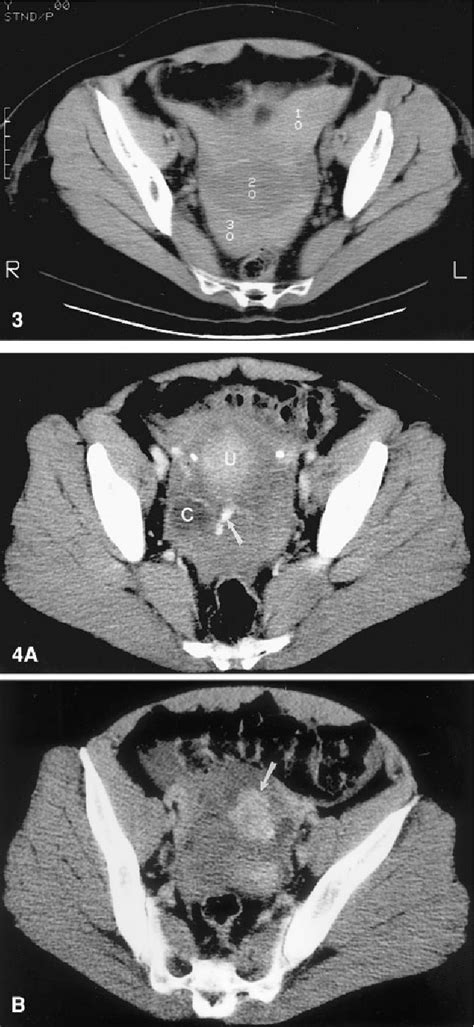ruptured ovarian cyst ct scan ct scan machine