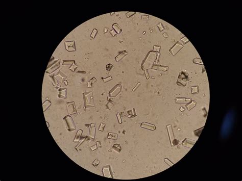 magnesium ammonium phosphate crystals  urine  large amounts