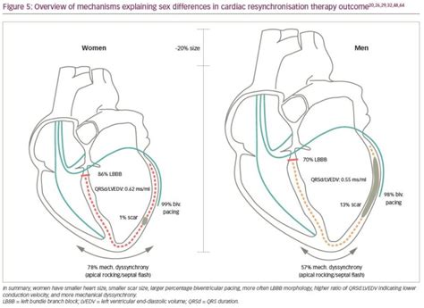 Explaining Sex Differences In Cardiac Resynchronisation Therapy Outcome