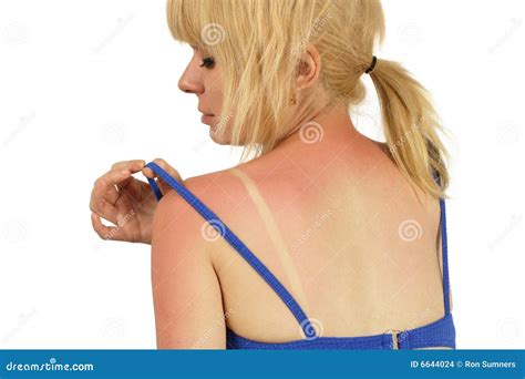 zonnebrand stock foto image  wijfje lichaam vrouw