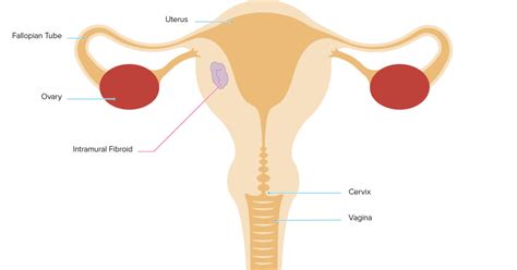 Intramural Fibroid Symptoms Diagnosis And Treatment