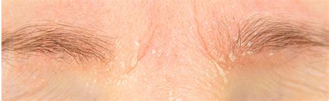 removing acne scars on sensitive skin dermatix® asia