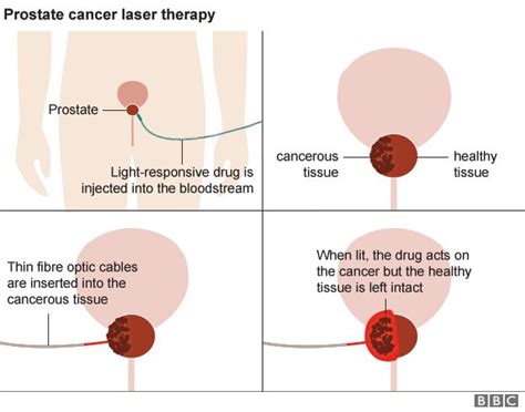 prostate cancer laser treatment truly transformative bbc news