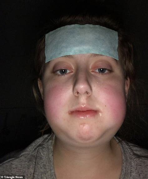 Bedale Teenager Jodie Bowers Bullied For Severe Overbite Gets Surgery