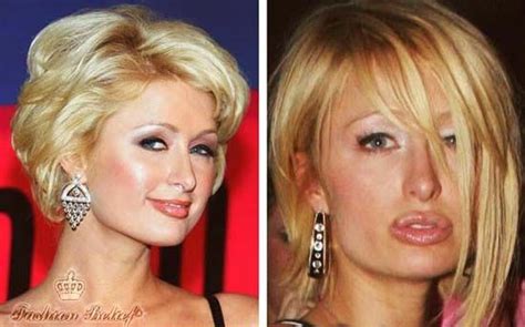Paris Hilton Lip Augmentation Bad Plastic Surgeries