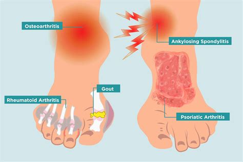 Arthritis In Your Feet Causes Symptoms And Treatment