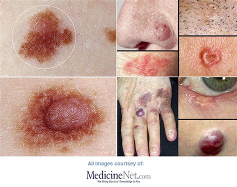 precancerous skin lesions  skin cancer pictures patients crossing