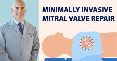 Surgeons Insights Minimally Invasive Mitral Valve Repair