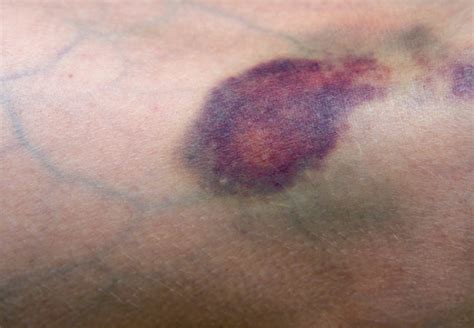 Do You Bruise Easily When To Get It Checked Out Health