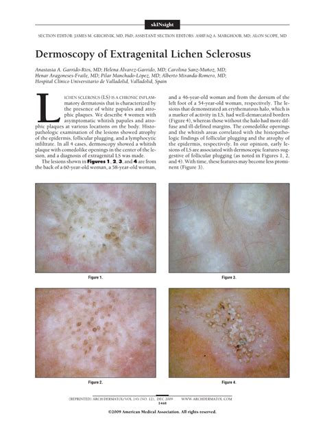 dermoscopy of extragenital lichen sclerosus dermatology