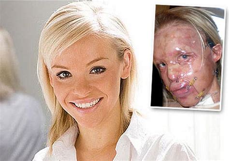 Katie Piper Before Attack
