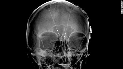 more evidence that deep brain stimulation may help treat