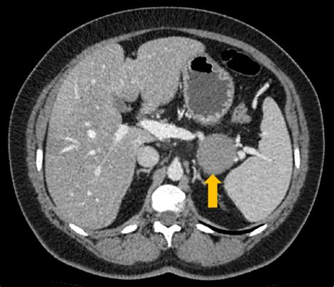 Figure 2 From Solid Pseudopapillary Neoplasm Of The Pancreas And