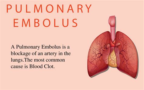 Pulmonary Embolism Explained Causes Symptoms And Treatment