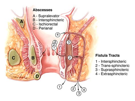 Abscesses And Fistula Tracts Of The Anorectum Art As