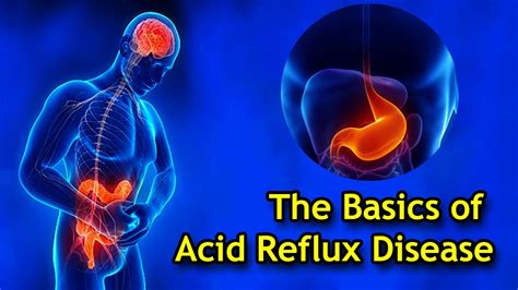 basics  acid reflux disease youtube