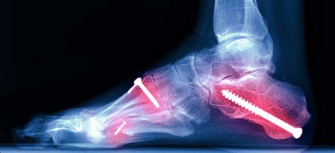 broken foot foot fracture  symptoms treatments recovery