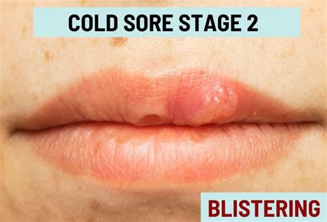 cold sore stages with pictures