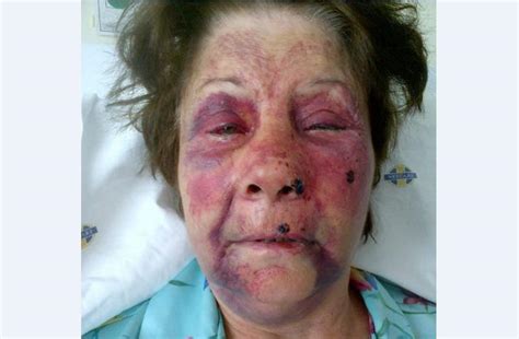 71 Year Old Woman Brutally Attacked