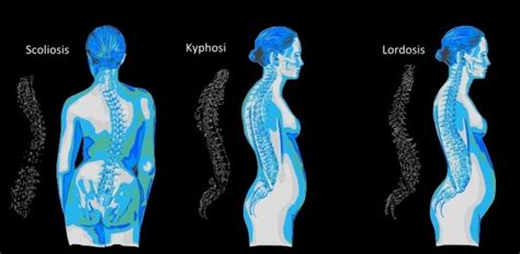 Lordosis Kyphosis And Scoliosis Cms Fitness Courses