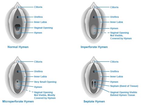 i m 19 and a virgin and have a septate hymen is it okay to have sex with a septate hymen or