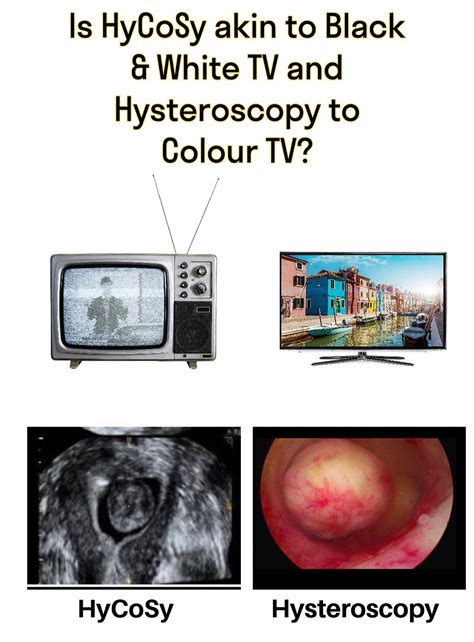 Hycosy Vs Hysteroscopy Is Hycosy Akin To Black And White Tv And