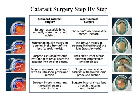 cataract surgery lenses types