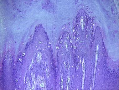 verruca plantaris histopathology loma linda dermatopathology