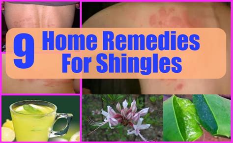 9 Best Shingles Home Remedies Treatments And Cures For Shingles