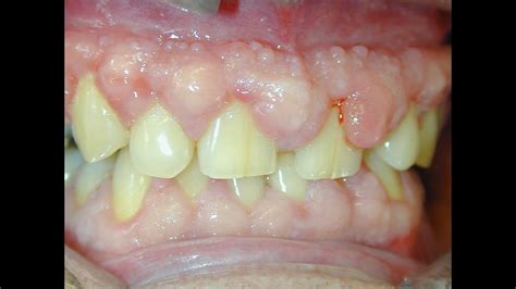gingival overgrowthenlargement  drugs periodontal surgery youtube