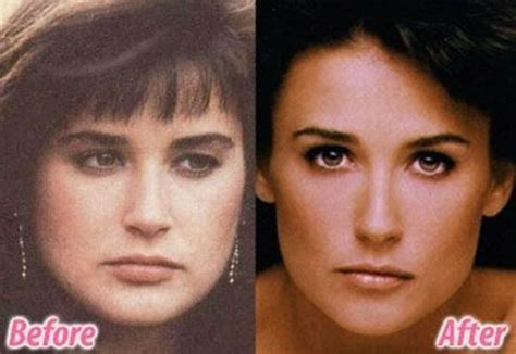 stars before and after plastic surgery 47 pics