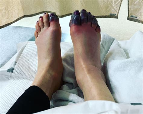 Climber Anna Pfaff To Lose Toes After Frostbite Explorersweb