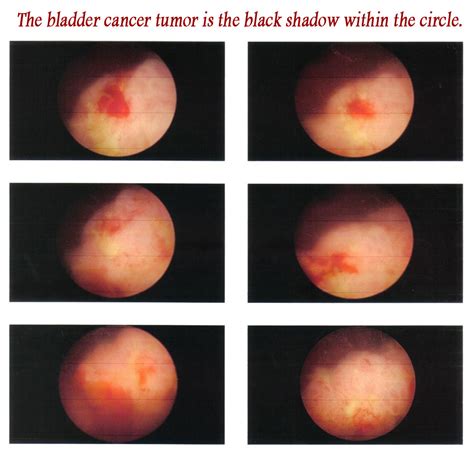 rife machine  bladder cancer testimonial tumor  urparamount