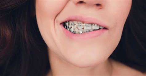 box rubber bands   braces braces