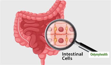 small intestine cancer know cause symptoms and treatment of this