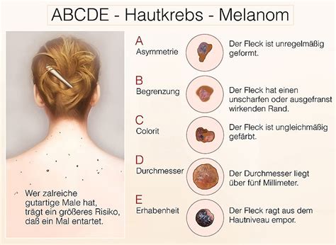 Hautkrebs Ursachen Symptome Hautarztzentrum Kiel