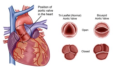 Bicuspid Aortic Valve Disease Cardiac Health