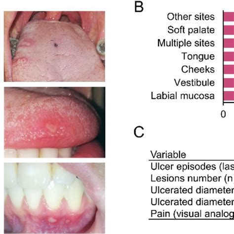 Clinical Manifestations Of Recurrent Aphthous Stomatitis A