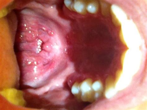 herpes roof of mouth photos